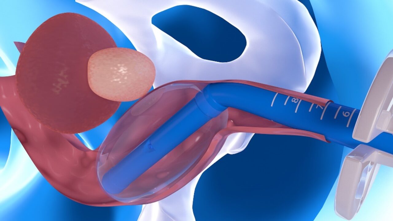Endorectal Balloon Qlrad