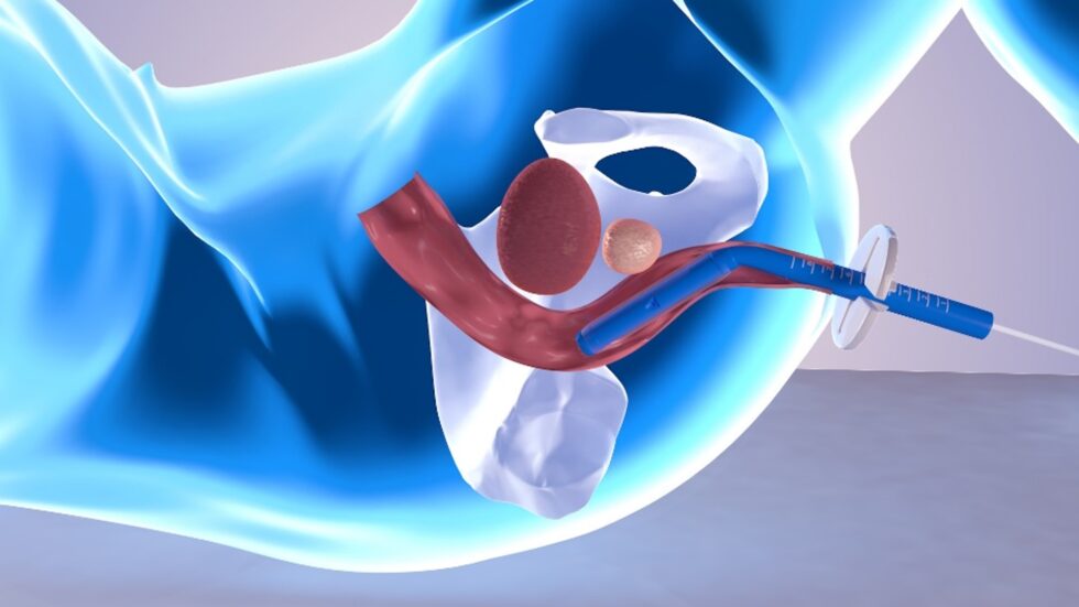 Endorectal Balloon Qlrad